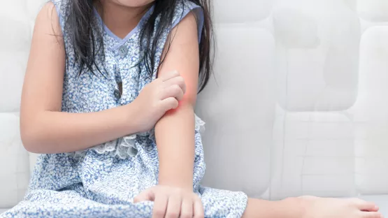 應對嬰幼兒濕疹或其他過敏問題 爸媽要知道