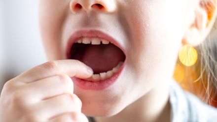 小朋友有幾多隻乳齒即睇換牙順序時間表